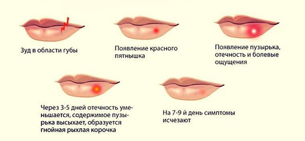 Герпес: причины, симптомы, лечение