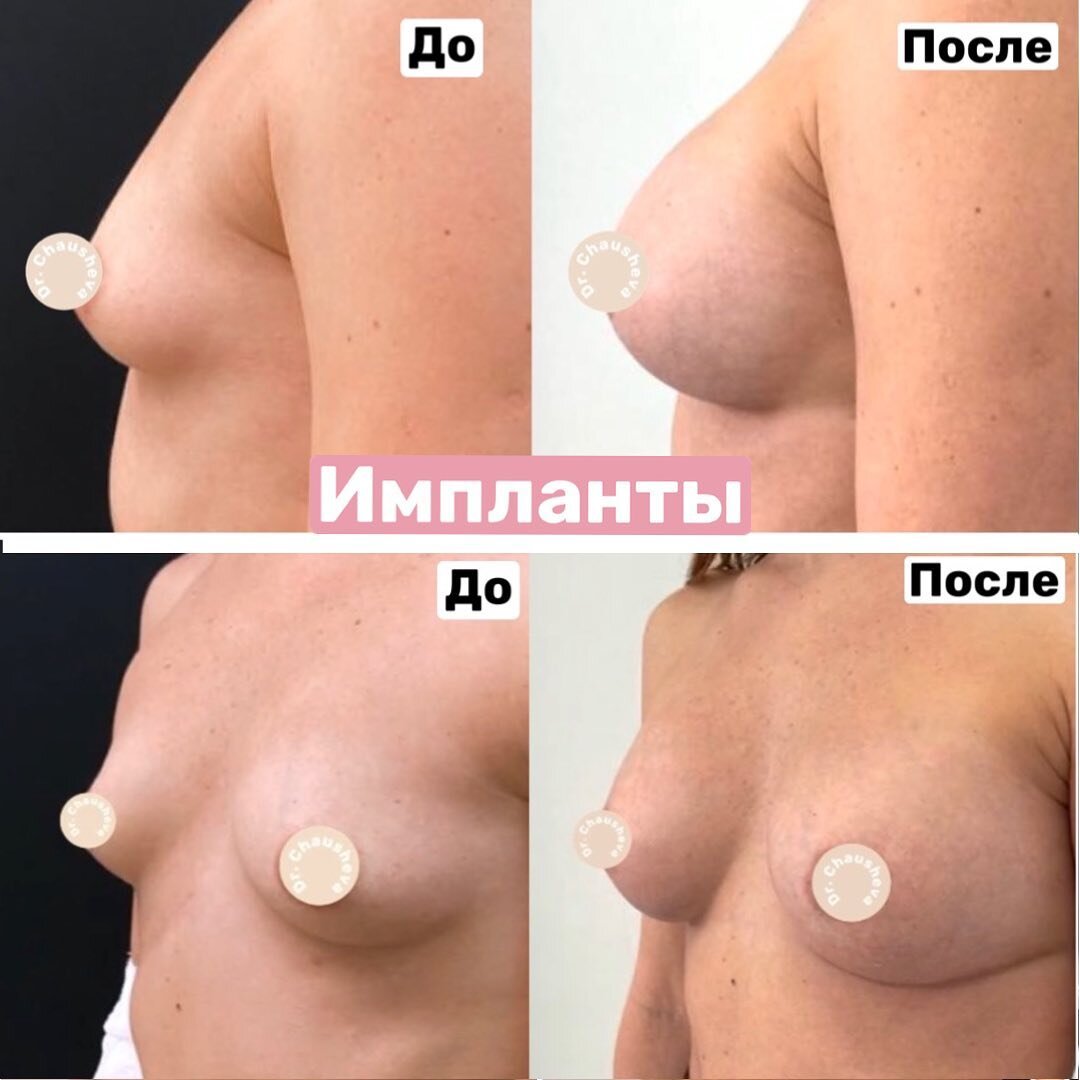 импланты для груди третьего размера фото 95
