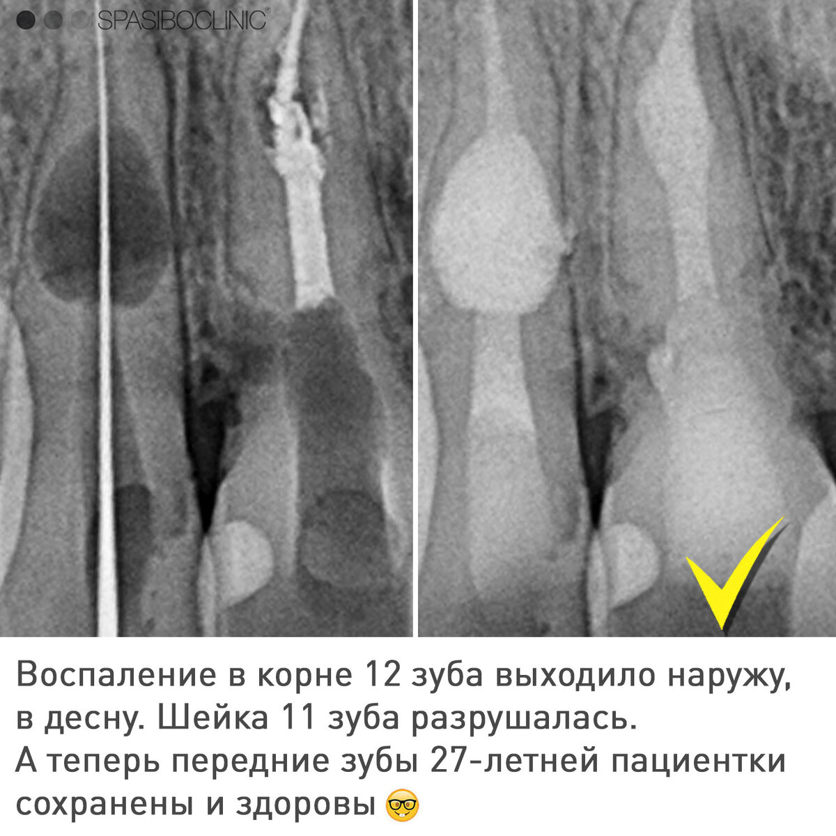 РЕЗОРБЦИЯ КОРНЕЙ | Спасибо.Клиник | Дзен