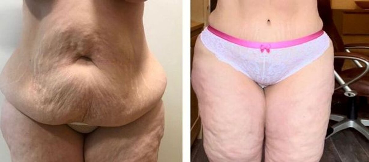    Живот Кейт Ричмонд до и после операции Фото: SWNS