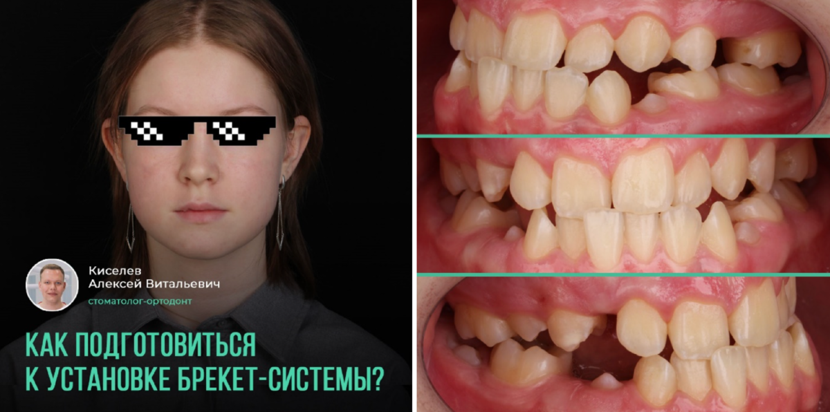 Что должен сделать врач-ортодонт перед лечением | записки зубного ...