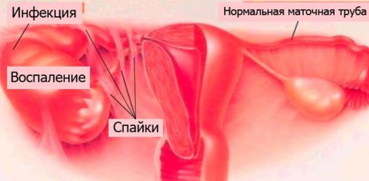 Воспаление маточных труб и придатков (сальпингоофорит)