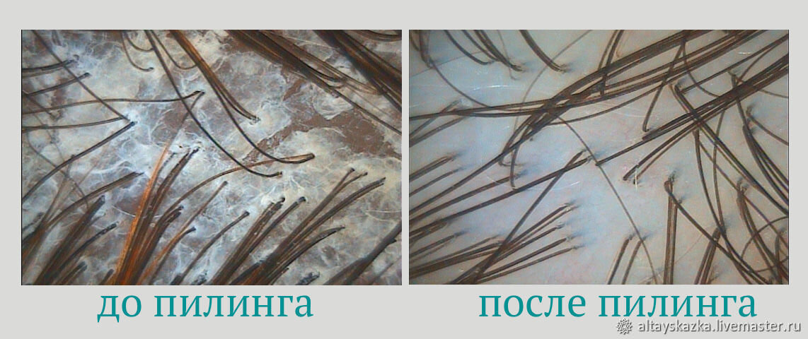 Пилинг кожи головы картинки