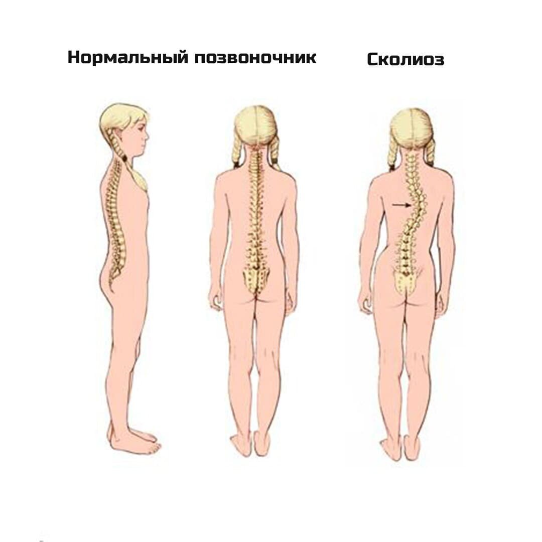 Сколиоз сдавливает внутренние органы и неравномерно распределяет нагрузку на тело