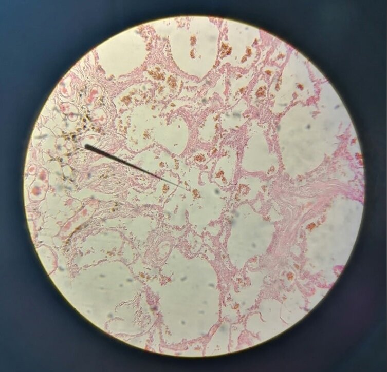 Бурая индурация легкого. Личный архив.