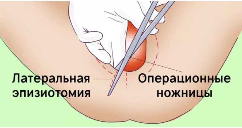 Перинеотомия и эпизиотомия презентация