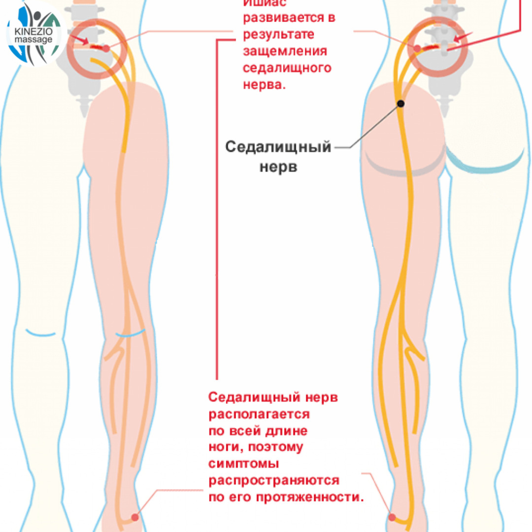 Помоги себе сам. Защемление седалищного нерва | Студия красоты и здоровья |  Дзен