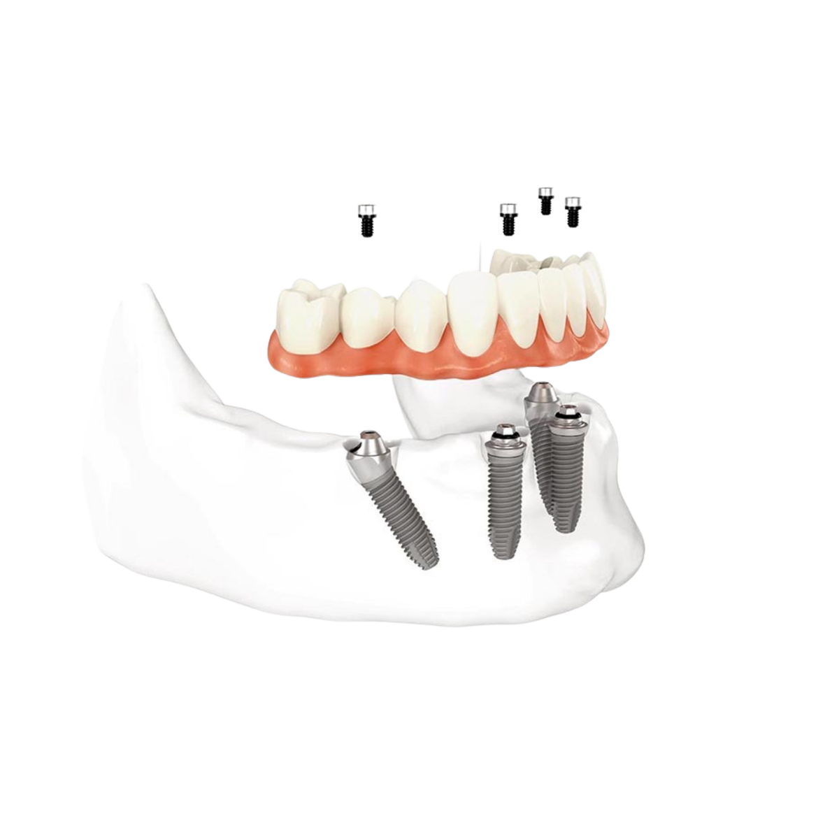 Имплантация зубов all on 6. Имплантация зубов all on 4. Микропротезирование отсутствующего зуба.