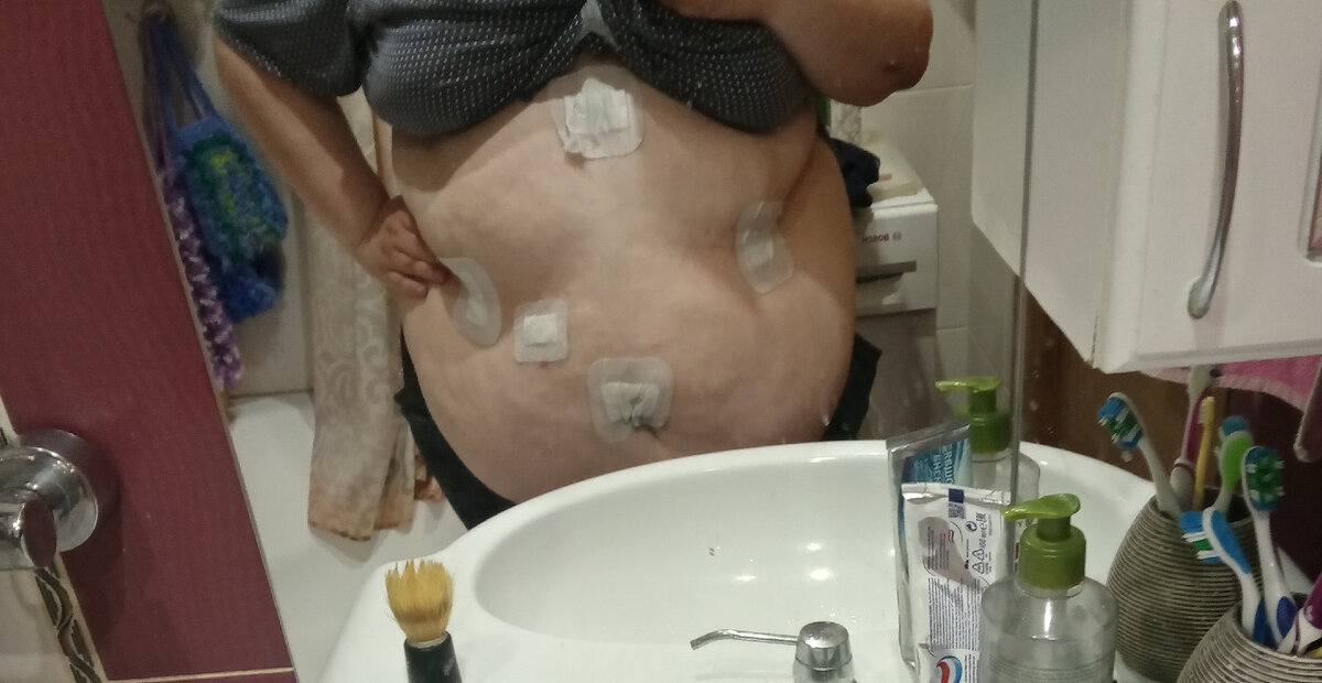 До обработки рубцов 