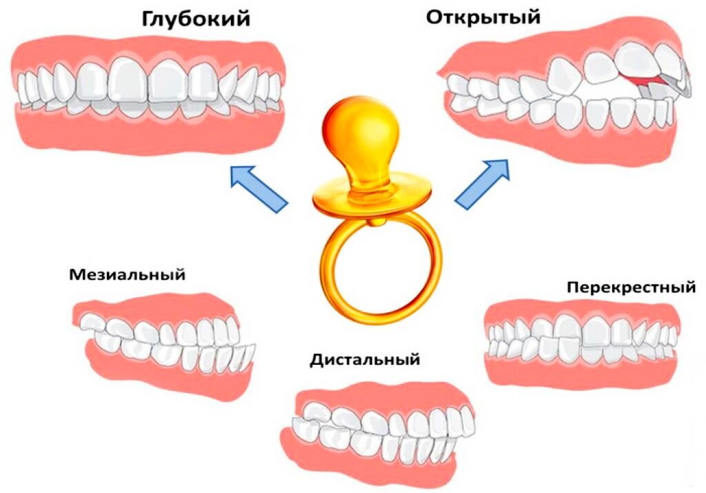 Неправильный прикус у ребенка - почему важно вовремя заметить и исправить?