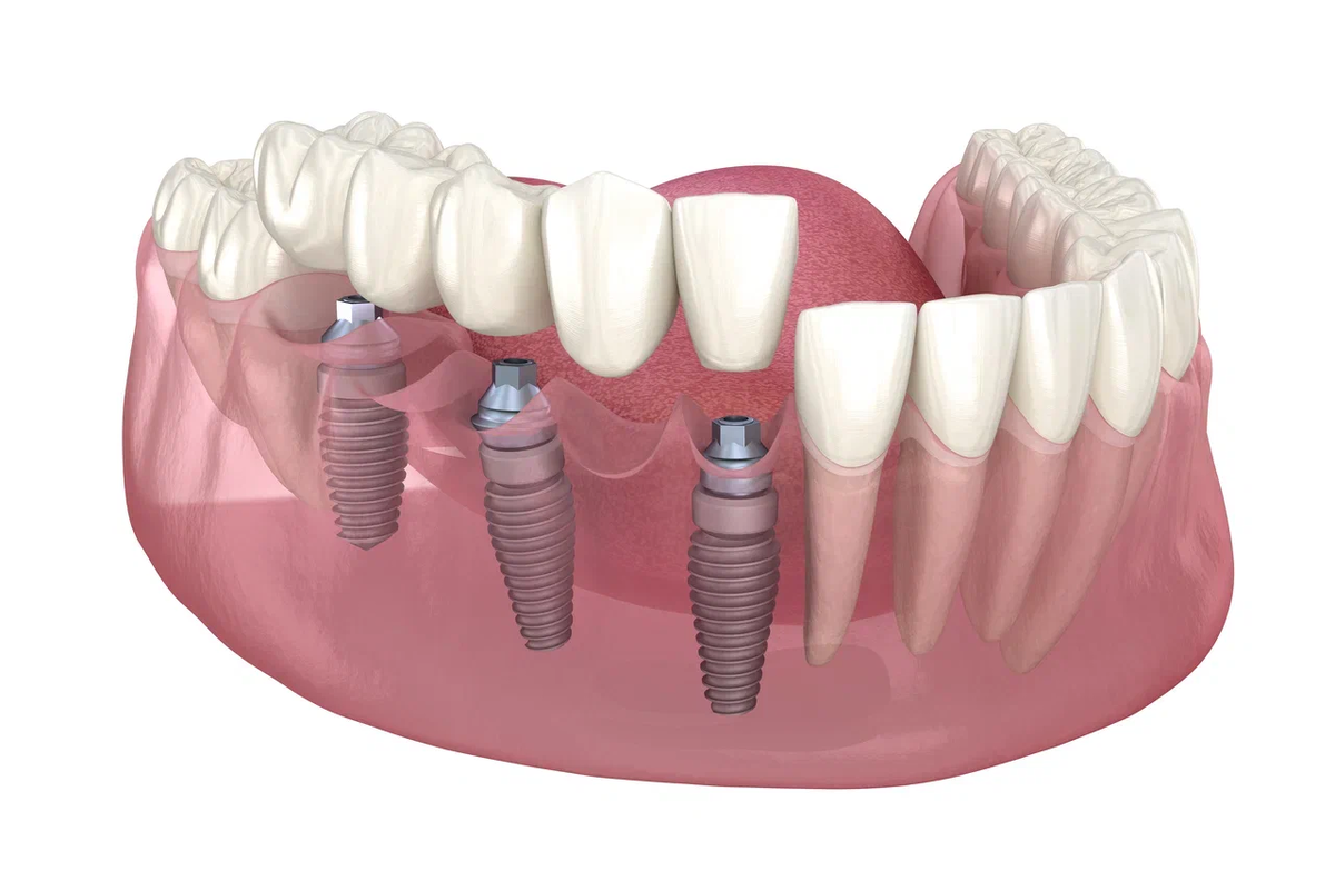 Можно ли с зубным имплантом делать мрт. Мост на имплантах на 3 зуба. Зубной мост на 3 зуба.