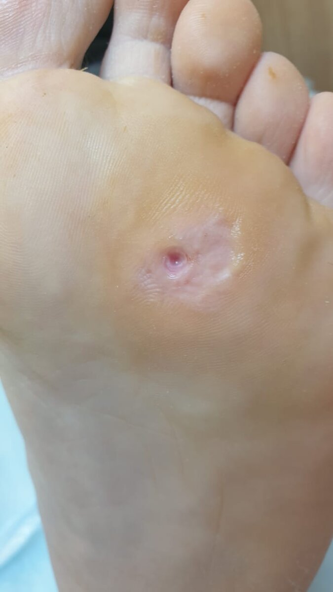 Начальный этап обработки стержневой мозоли.