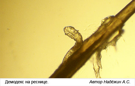 Подкожный клещ на ресницах фото ПОД СТЕКЛОМ: ДЕМОДЕКОЗ. Как диагностировать и лечить. А410 Дзен