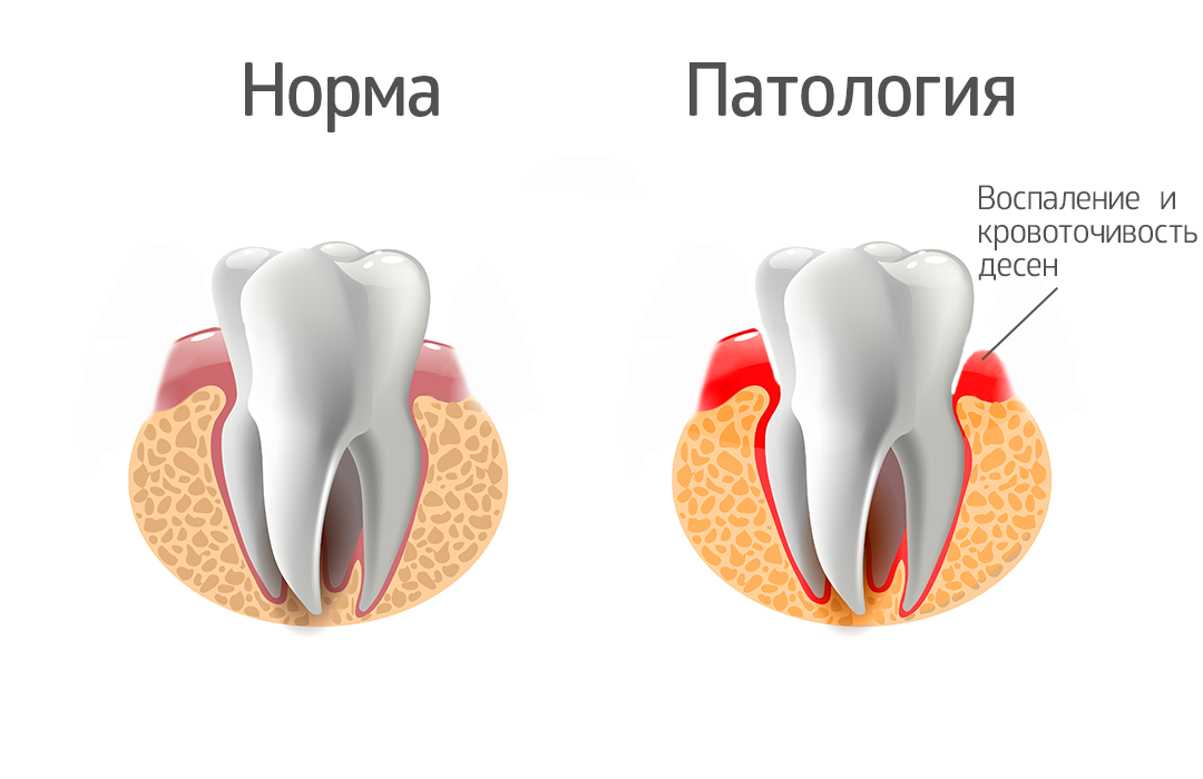 Лечение десневых карманов