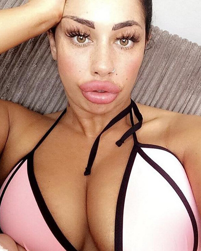 Самые большие губы в мире: 8 девушек, изуродовавших себя филлерами