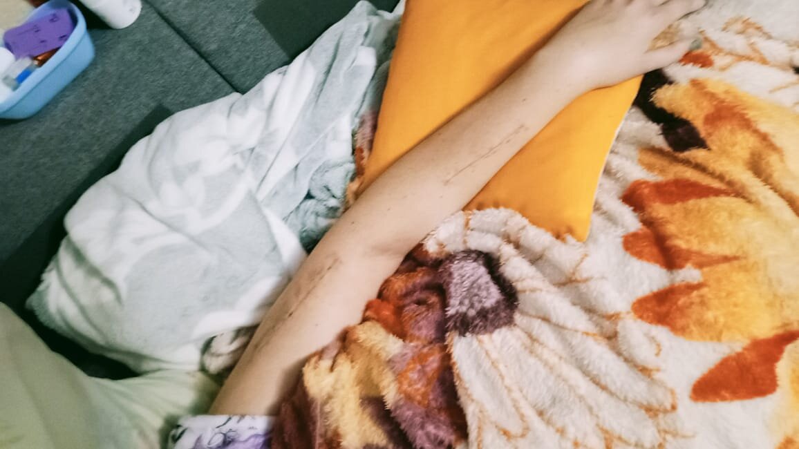 Отмечу, что зашили очень аккуратно и бережно. Вы можете даже сравнить, какой шов с Аксайской больницы, накладывали на ноге Юли и какой сделали на руке, врачи из Ростова. Разница колоссальная. Фото шва(на ноге) в первой статье.