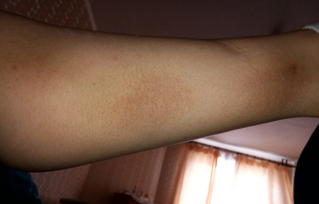 Пигментные пятна. Могут появиться если перед эпиляцией был неправильно определен фототип кожи. Из-за чего неподходящим образом настроили лазер. Также они случается при неправильном постпроцедурном уходе за местом обработки