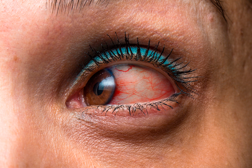 Иридоциклит и другие увеиты