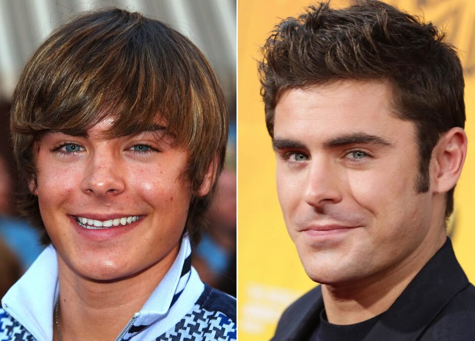 Зак Эфрон до и после ринопластики. Имеются противопоказания, необходима консультация специалиста. Foto by AbobeStock