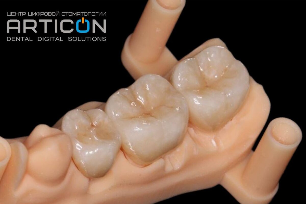 Коронки, изготовленные по цифровым протоколам в лаборатории Articon