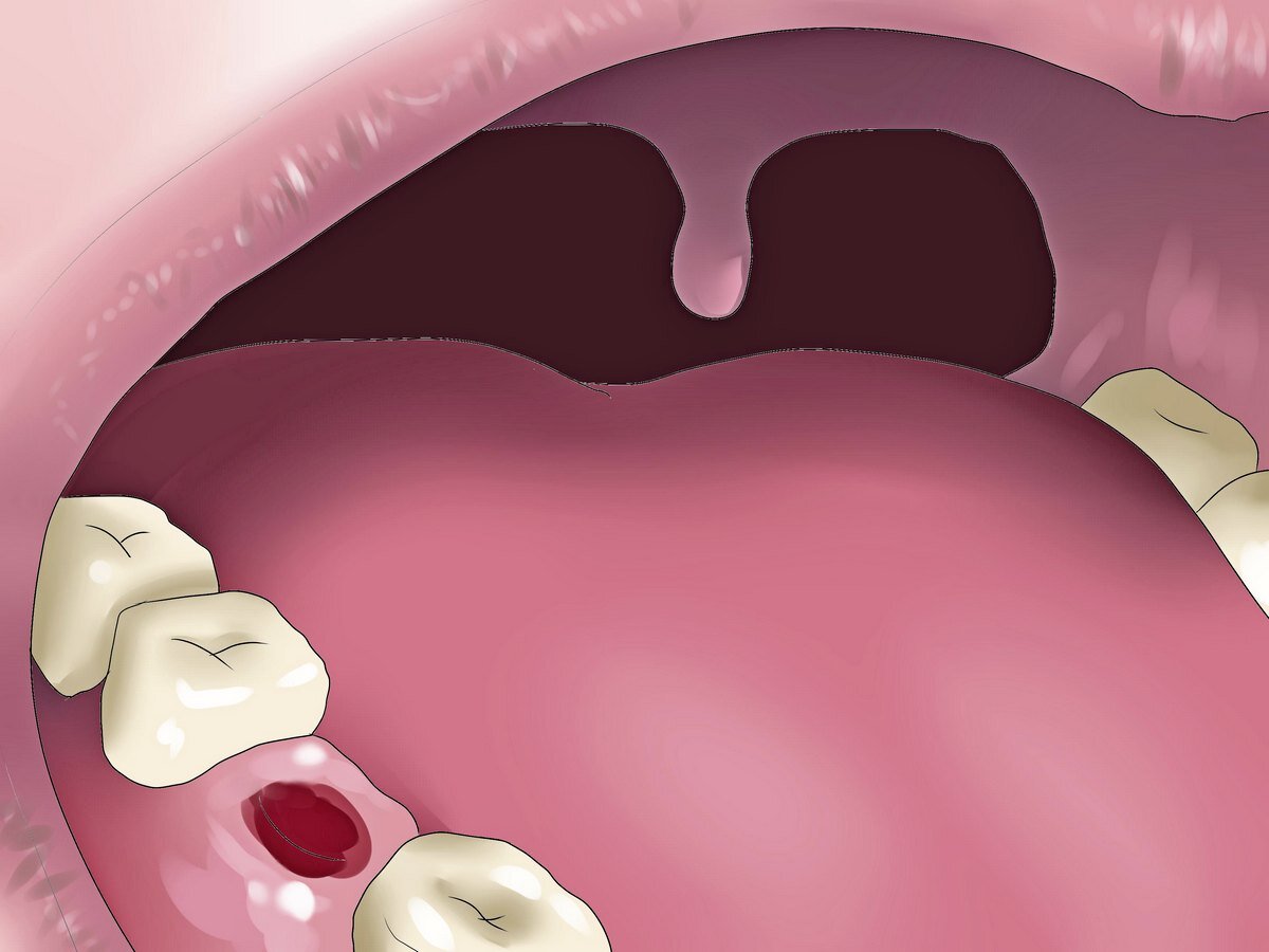 Альвеолит после удаления зуба - симптомы и лечение альвеолита