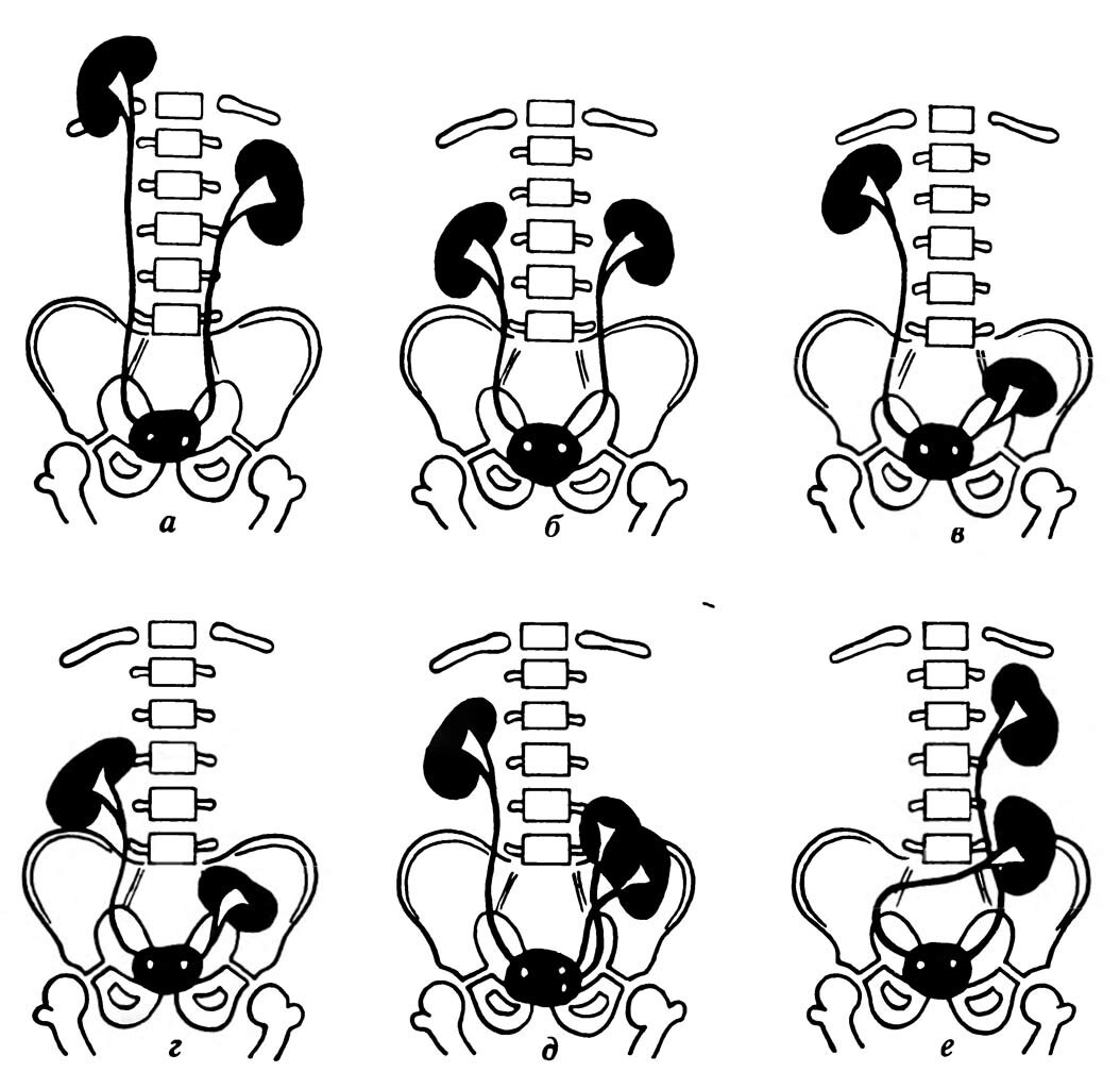Дистопия почки. Дистопия (эктопия) почек. Поясничная дистопия почки. Аномалии развития почек дистопия.