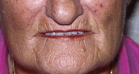 Видите как стянулись губы? Осталась лишь токая полосочка красной каймы.