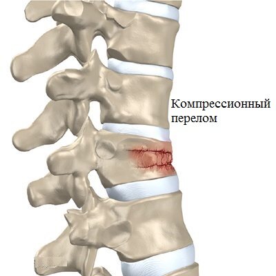  Виды перелома позвоночника