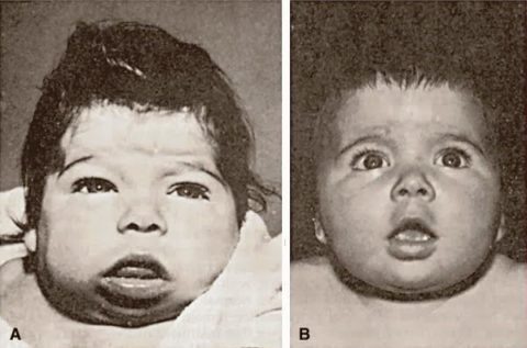  Видимые отличия между больным гипотиреозом и здоровым ребенком
