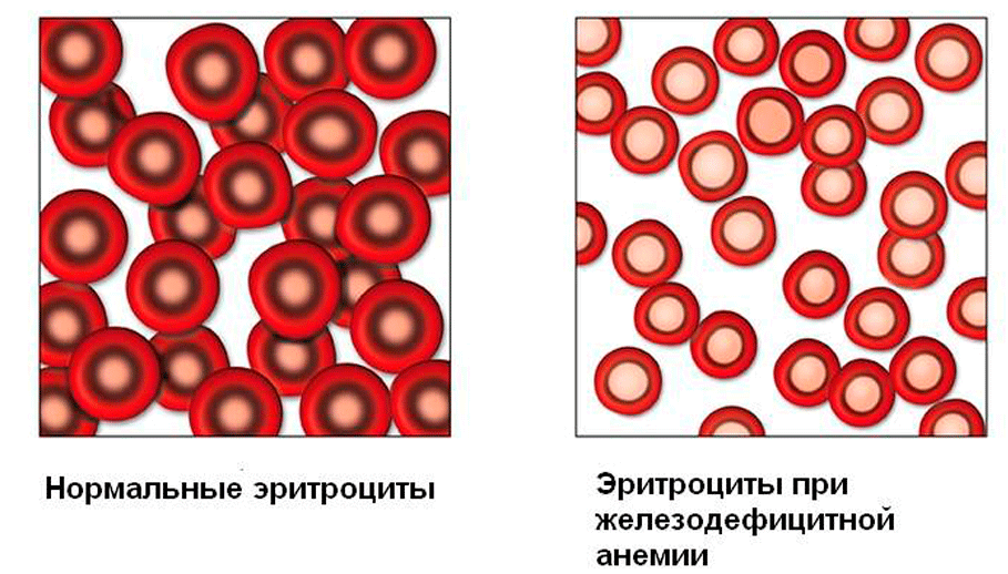 Анемия и эритроциты в крови. Железодефицитная анемия картина крови. Гипохромия и микроцитоз характерны для. Гипохромная анемия картина крови. Железная дефицитная анемия.
