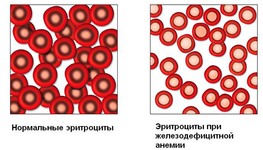 Анемия и эритроциты в крови