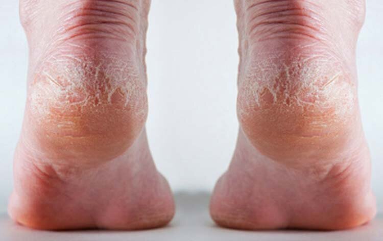           У многих женщин с возрастам трескается кожа на пятках. Пятки становятся болезненны и не привлекательны. Такое происходит из за очень сухой кожи. Пятки могут начать трескаться не зависимо от поры года. Для многих эта проблема возникает в зимние месяца, для некоторых кто проживает в сухом климате сезонность не имеет значения.