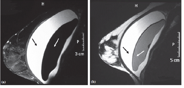 липосакция, пластика живота, ринопластика, пластика носа, пластический хирург, септопластика, изменить нос, маммопластика, пластический хирург, здоровье, красота, пластика груди, увеличение груди, москва
