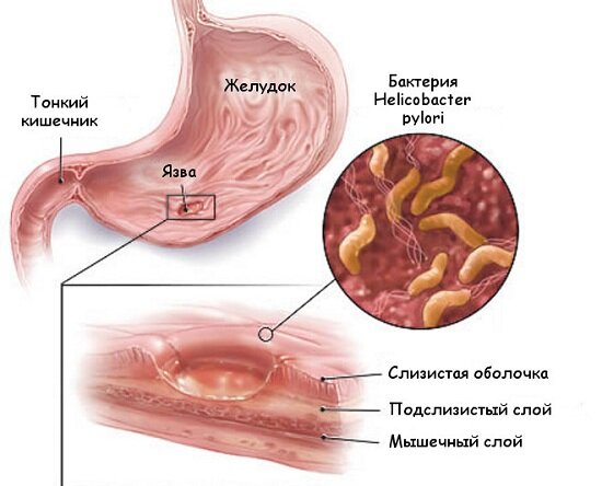 Гастрит и язвенная болезнь