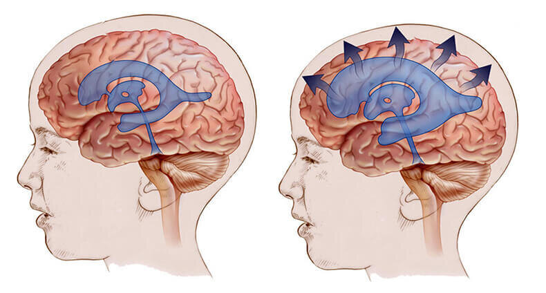 Повышенное внутричерепное давление у ребенка