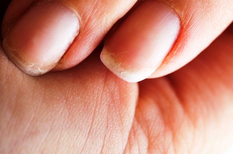 Почему слоятся ногти и что делать