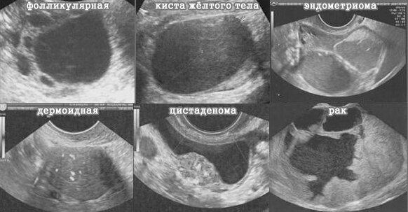 Различные типы кист яичника на УЗИ