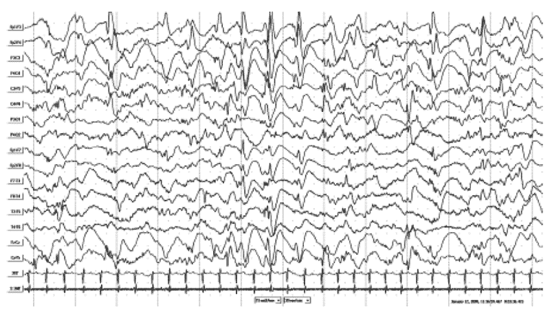 Так выглядит активность мозга на ЭЭГ