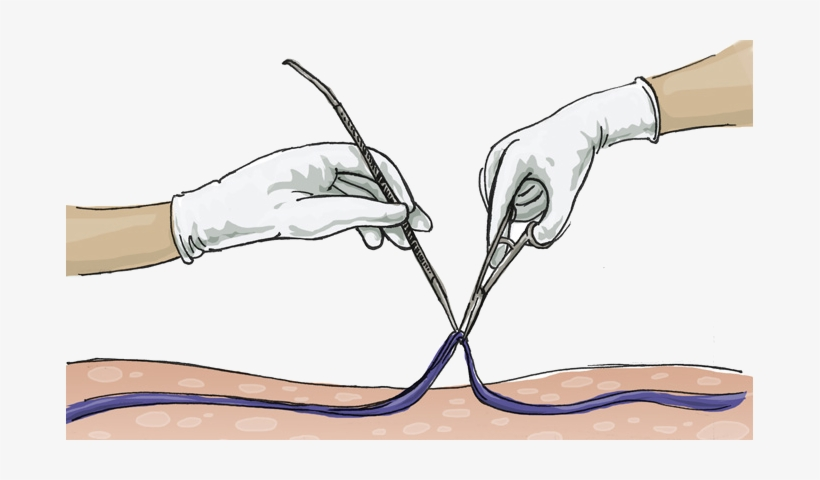 Флебэктомия