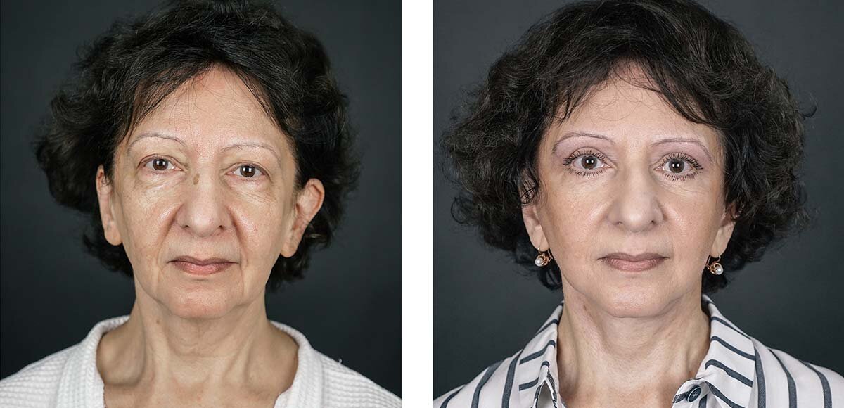 Результат круговой подтяжки лица и круговой блефаропластики спустя 3 месяца после операции. 