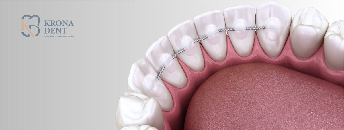 Ретейнер для зубов – что это, цена, установка ретейнеров после брекетов