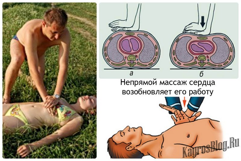 Массаж сердца. Как делать непрямой массаж сердца. Как делается непрямой массаж сердца. Как делать массаж сердца.