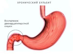 Лечение бульбита