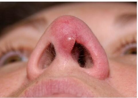  Шарик под кончиком носа