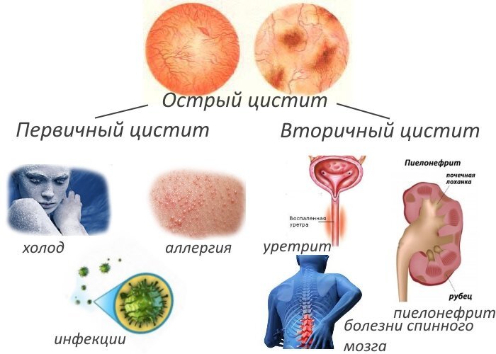 Посткоитальный цистит: что нужно знать?