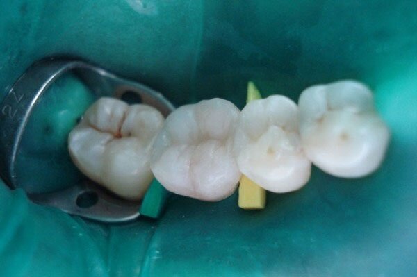 Коффердам при стоматологическом лечении