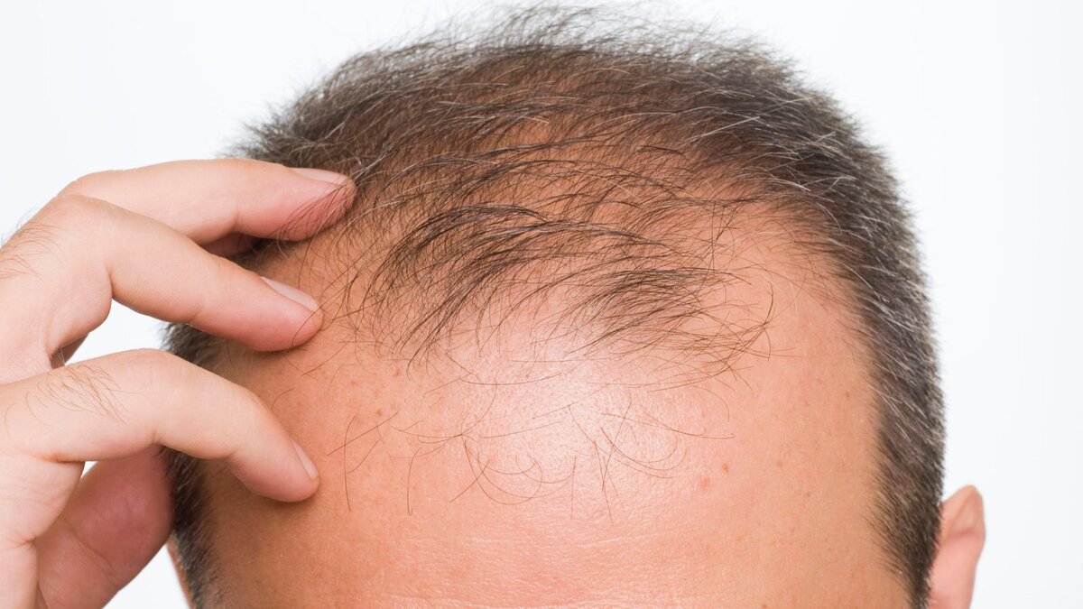 Выпадение волос у мужчин: как остановить и что делать, чтобы вылечить
