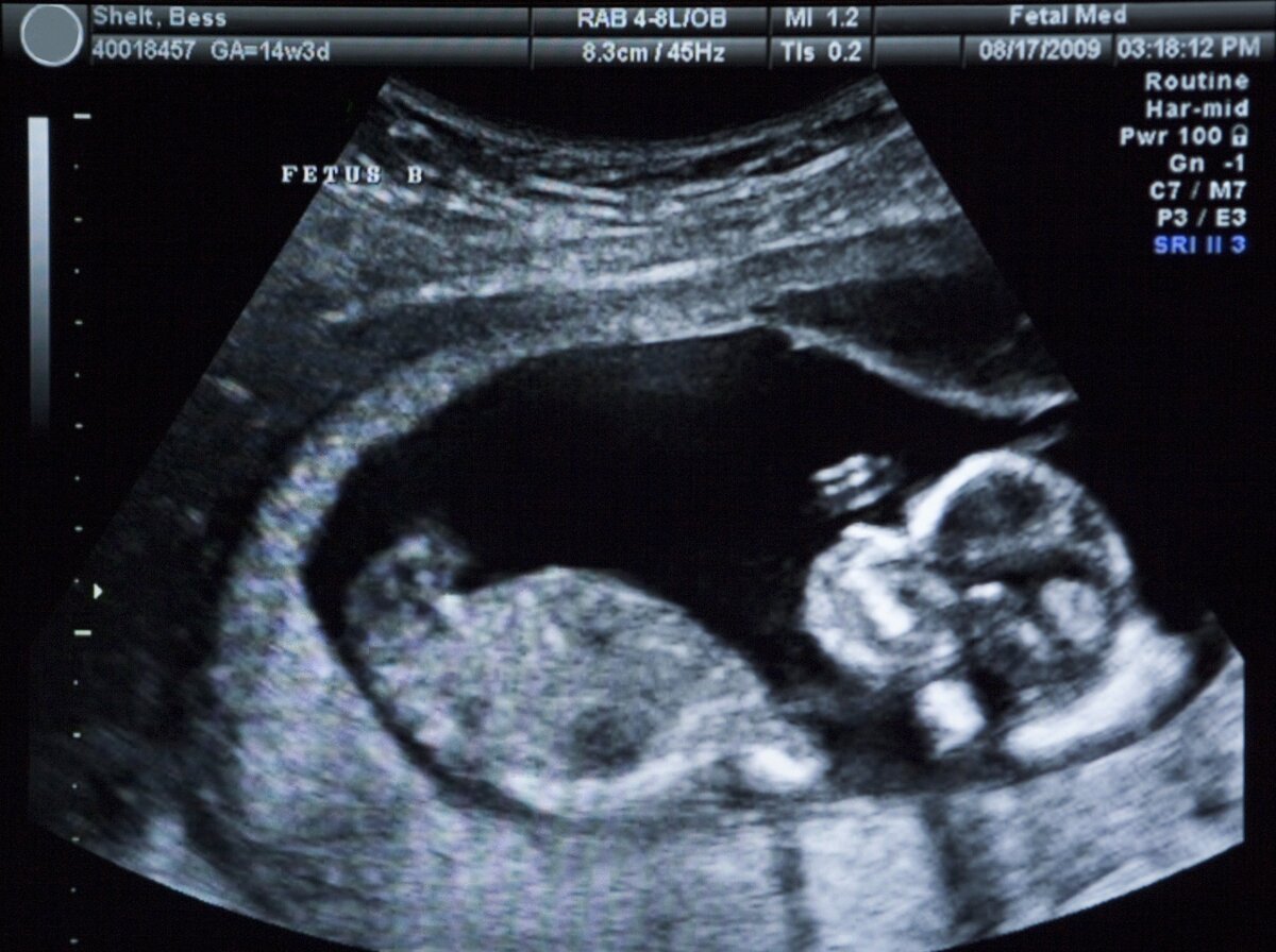 Пол ребенка фото на 14 неделе беременности фото