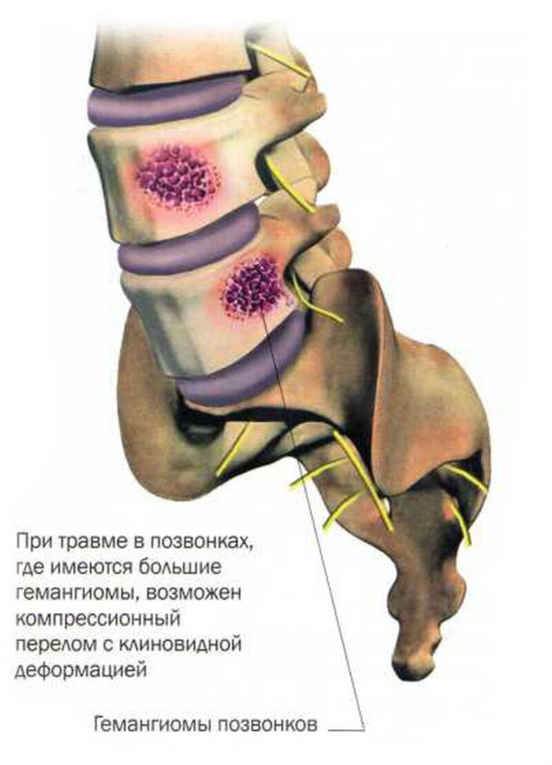  Гемангиома кости (позвоночника) 