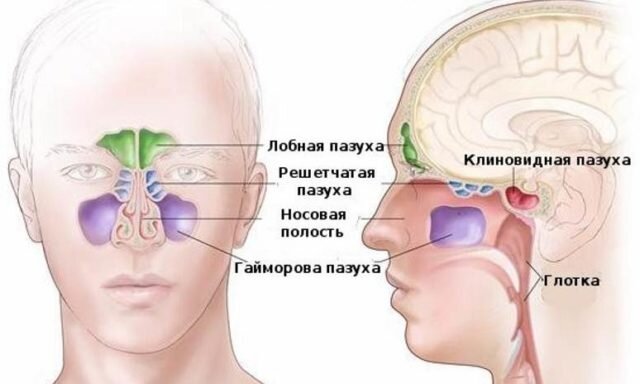 Киста верхнечелюстной пазухи